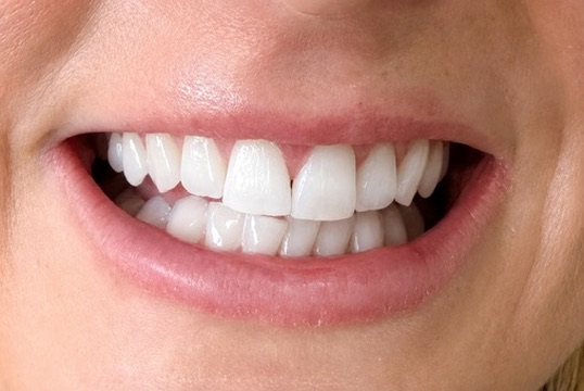 After one laser teeth whitening appointment, Christchurch