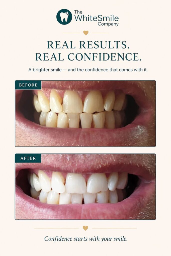 Comfortable teeth whitening before and after in Christchurch — a brighter, whiter smile